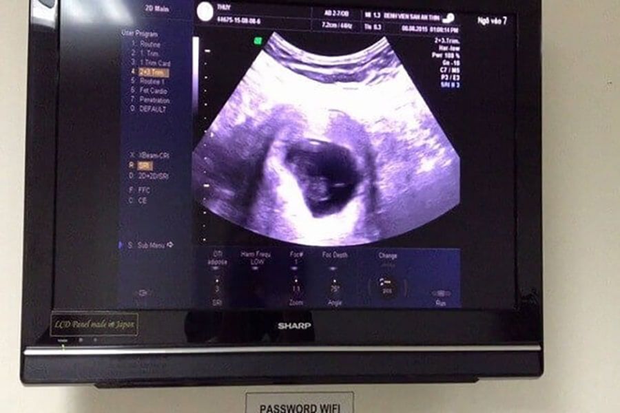 Một số hình ảnh siêu âm của thai nhi vào tuần tuổi thứ 5