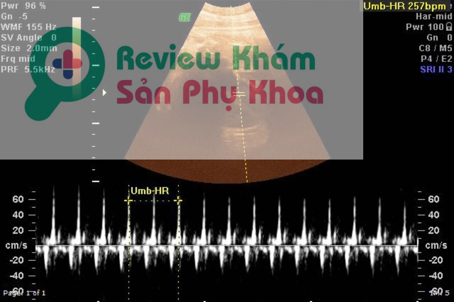 Thiếu tim thai do sảy thai tự nhiên