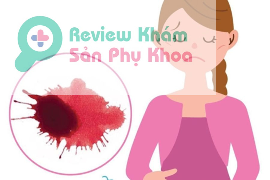 Siêu âm không có tim thai ở tuần thứ 8 có thể do bị thai ngoài tử cung