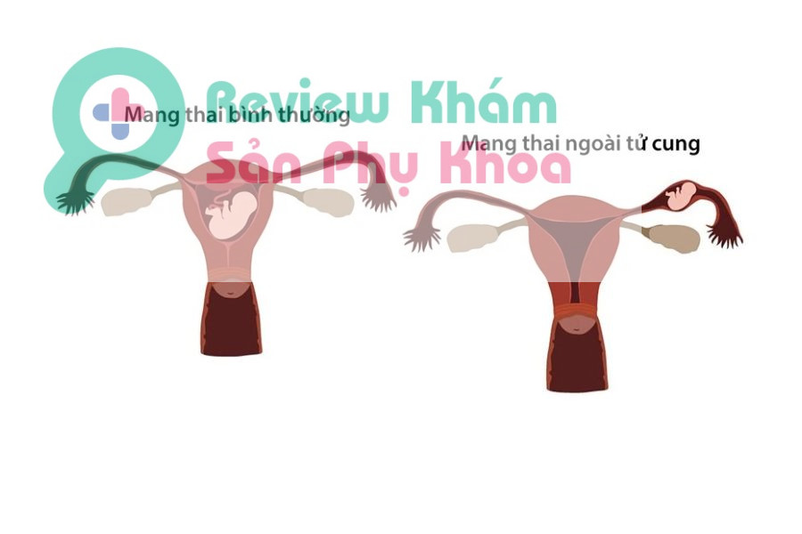 Rối loạn sự phát triển thai nhi cũng làm cho việc siêu âm không có tim thai ở tuần thứ 8