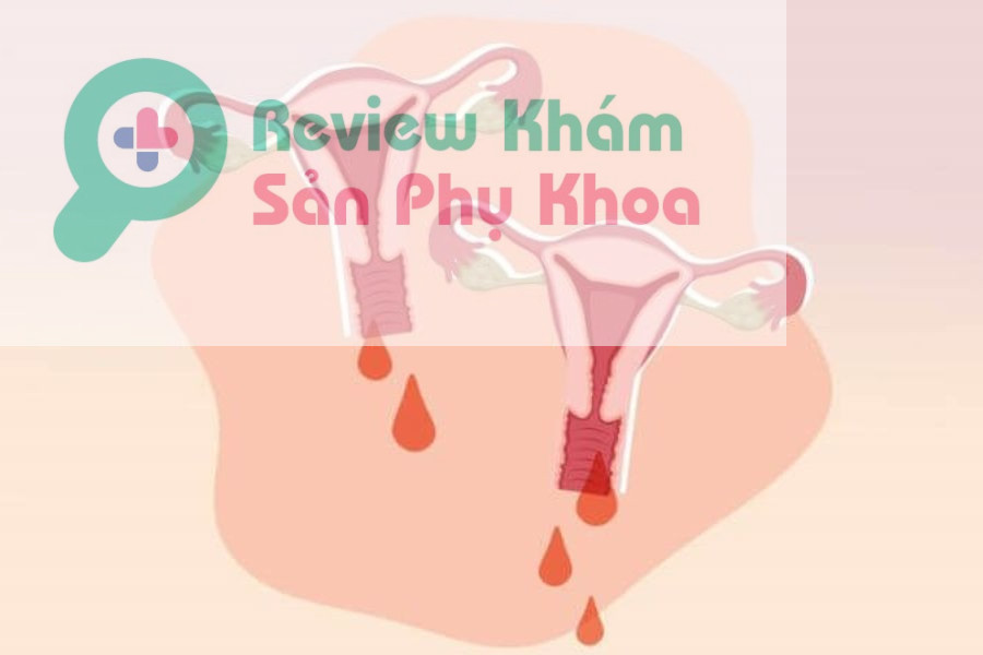 Biểu hiện chửa ngoài dạ con
