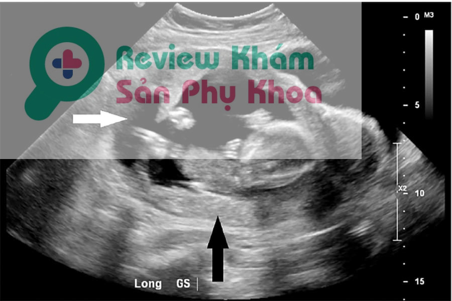 Kết hợp thăm khám lâm sàng và kỹ thuật như đánh giá hormone, siêu âm để chẩn đoán thai ngoài tử cung tự tiêu