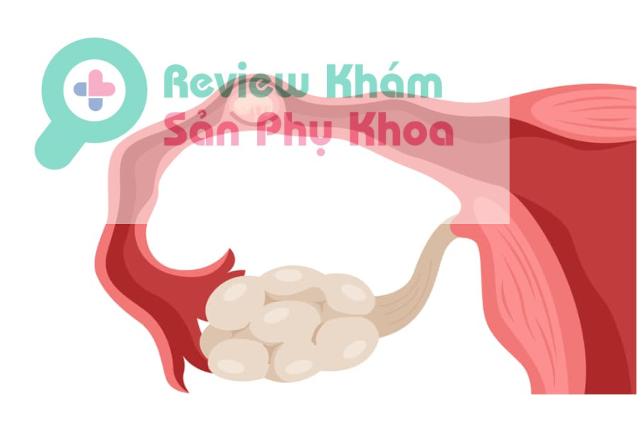 Có thai ngoài tử cung có kinh không?