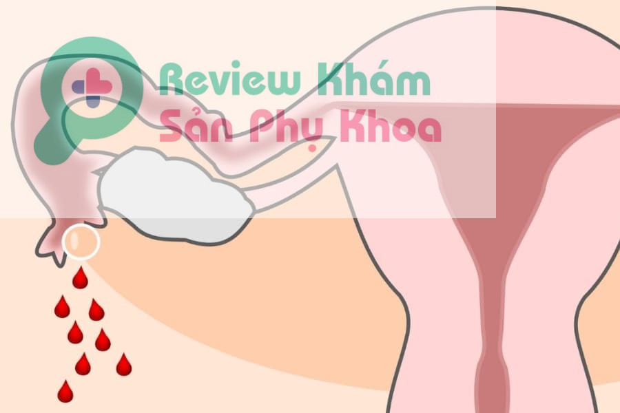 Liệu có thai ngoài tử cung có kinh không?