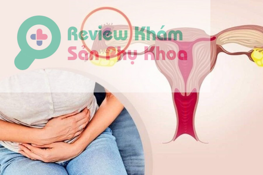 Mang thai ngoài tử cung có giữ được không?