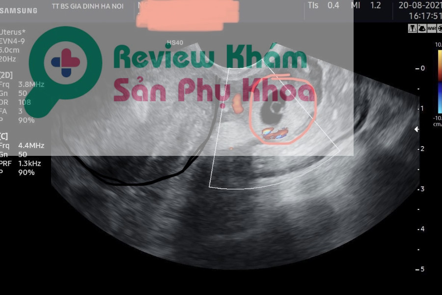 hình ảnh siêu âm thai ngoài tử cung