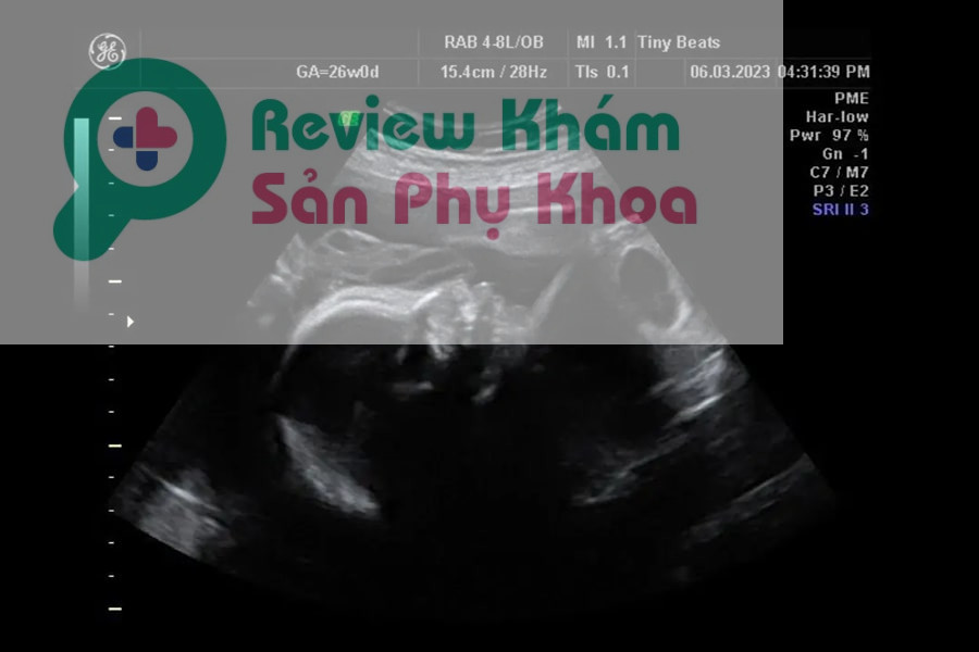 Hình ảnh siêu âm 2D