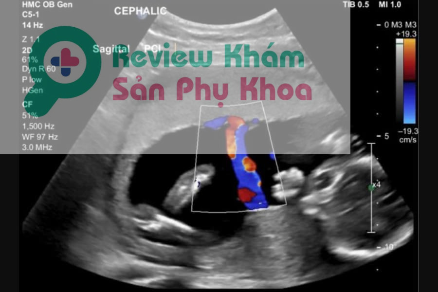Nguyên lý hoạt động của siêu âm doppler thai dựa trên hiệu ứng doppler