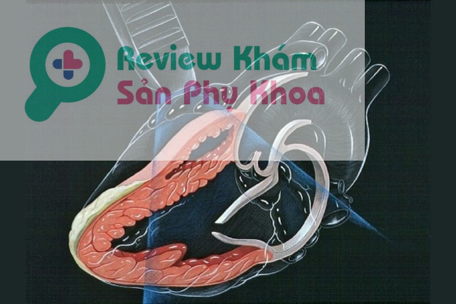 Siêu âm Doppler đánh giá được bệnh lý của tim một cách chính xác nhất