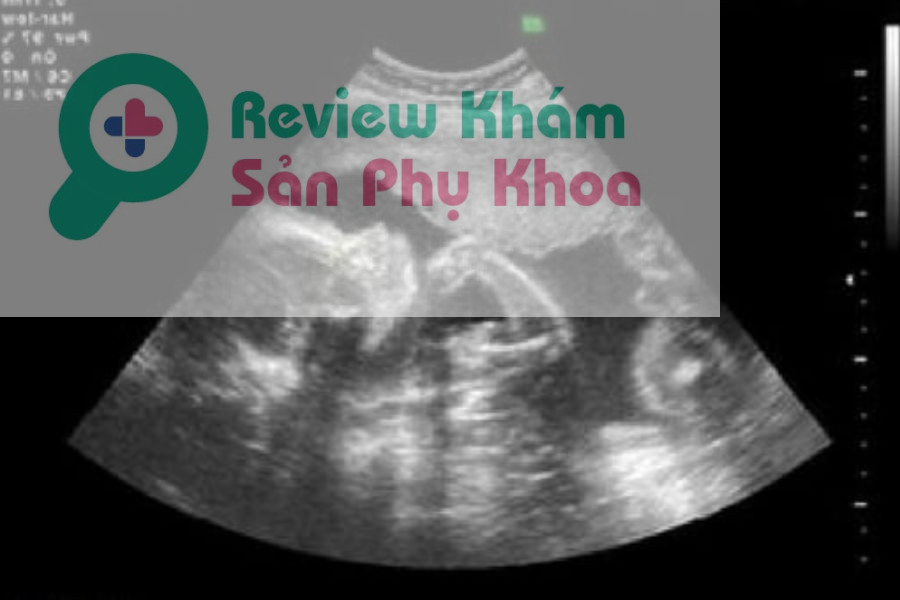 Siêu âm nhiều có tốt cho thai nhi không