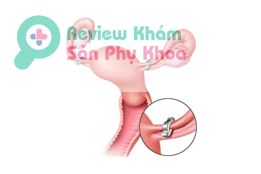 Các phương pháp triệt sản nữ