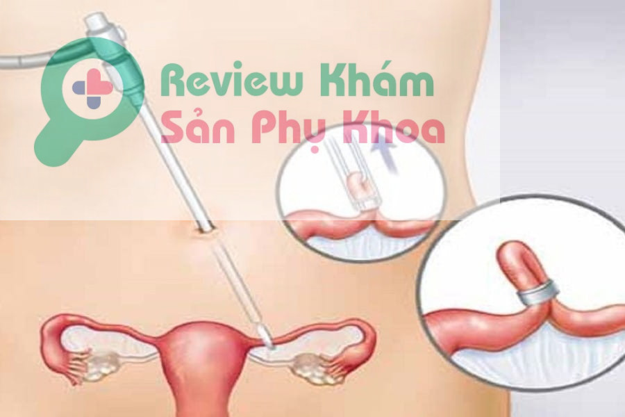 Có nên thắt ống dẫn trứng