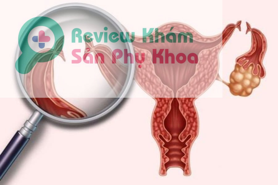 Thắt ống dẫn trứng có làm ivf được không?