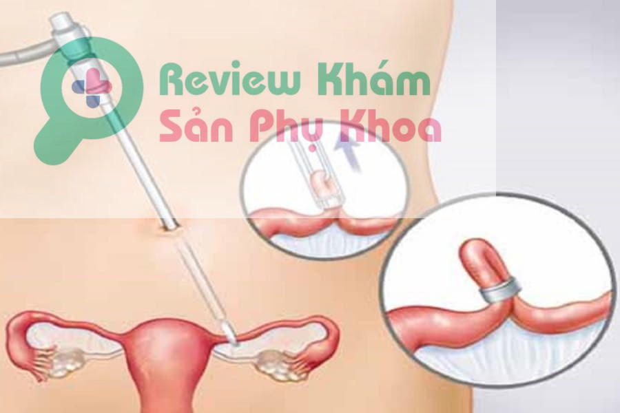 Sản phụ sinh thường có thắt ống dẫn trứng được không?