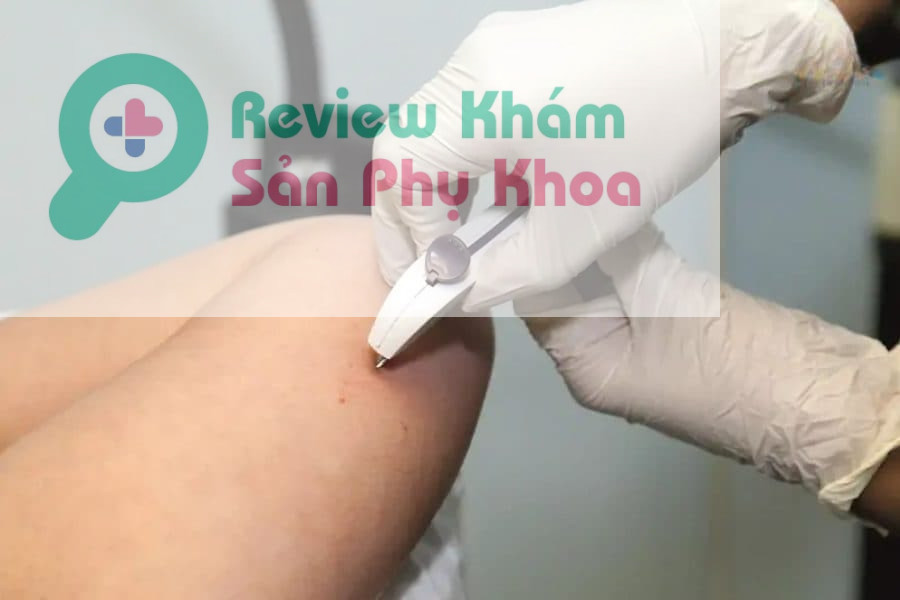 Phương pháp cấy que tránh thai có tốt không?