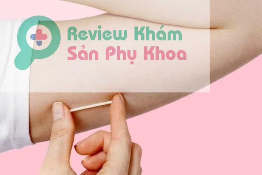 Cấy que tránh thai là gì?