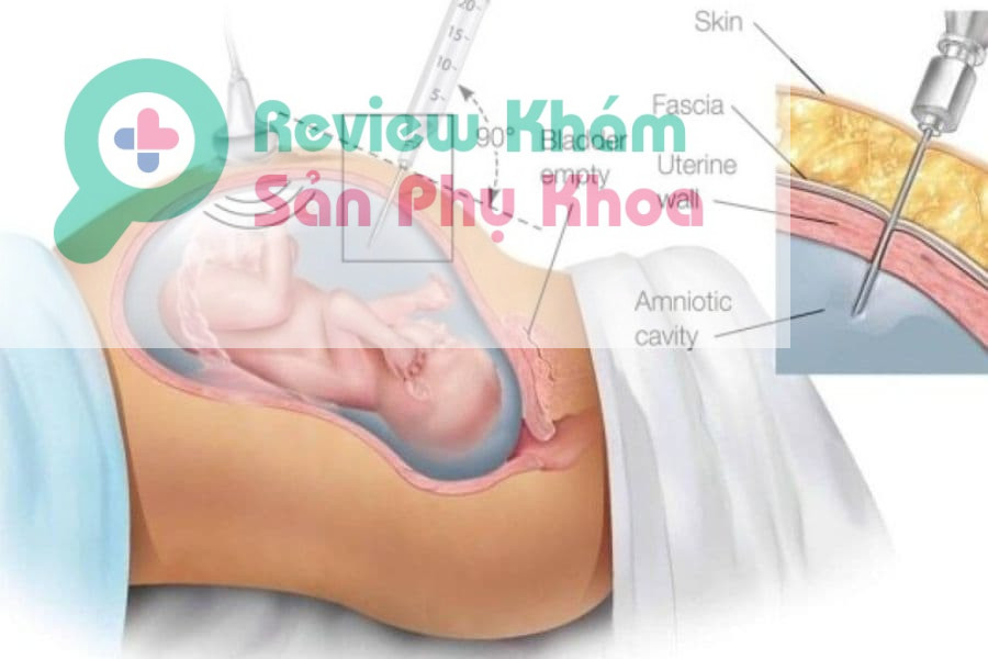 Có những gói khám sàng lọc trước sinh nào phổ biến?