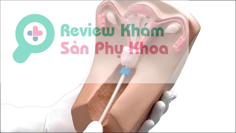 Tiện lợi, nhanh chóng, hiệu quả cao là những ưu điểm mà phương pháp đặt vòng tránh thai đem đến cho chị em phụ nữ