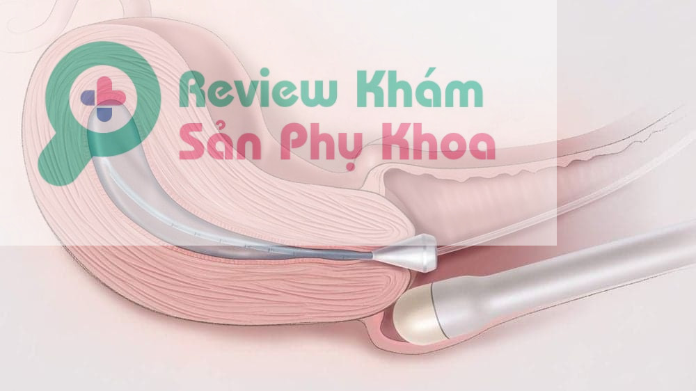 Ưu điểm và hạn chế phương pháp siêu âm dò đầu âm đạo