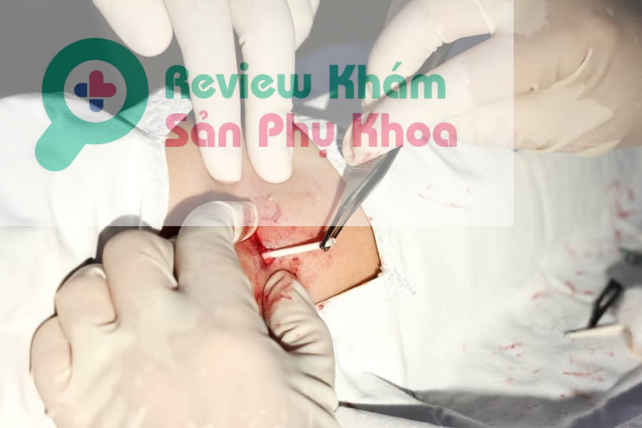 Chị em nên thực hiện cấy que tránh thai khi nào là tốt nhất