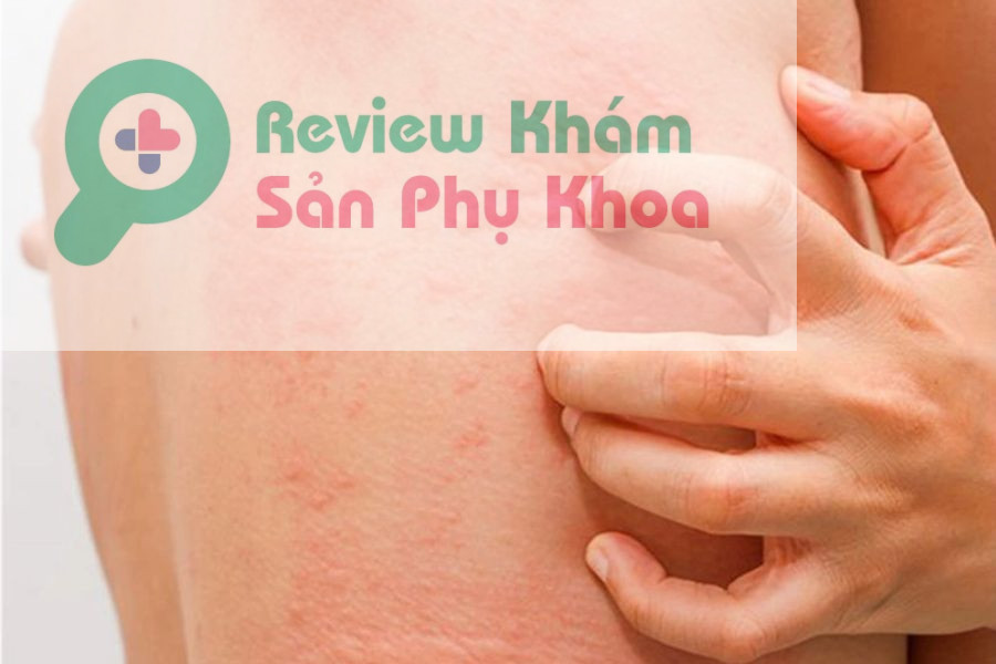 Nổi mẩn đỏ sau khi quan hệ