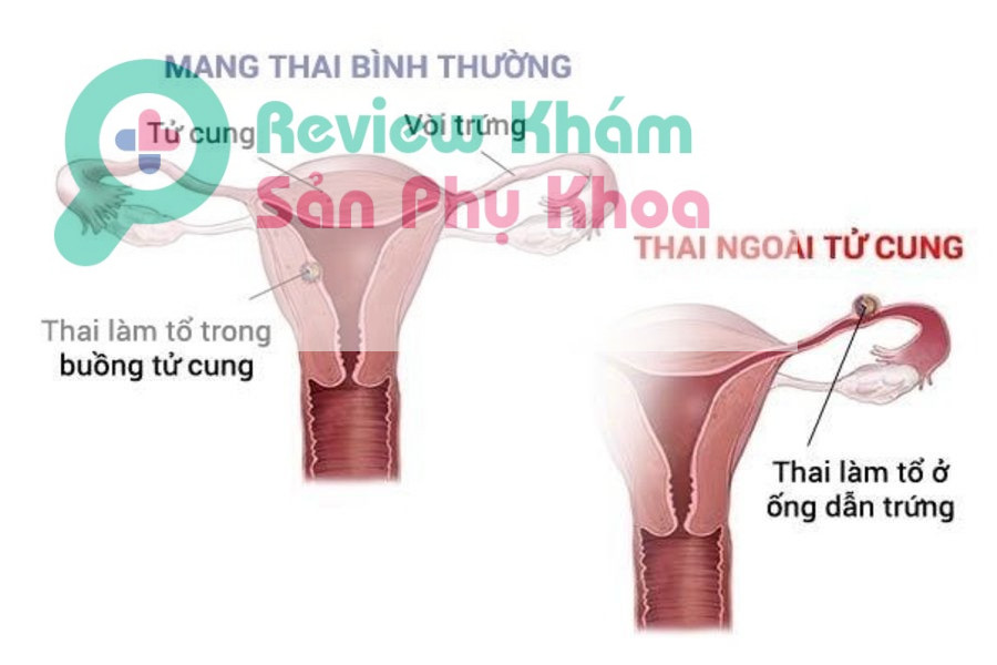 ra khí hư màu nâu có mùi hôi